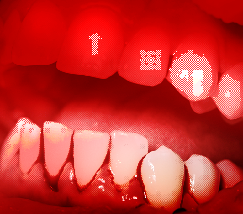 Aperfeiçoamento em Estética Vermelha e Branca e Prótese Sobre Implante (PSI)