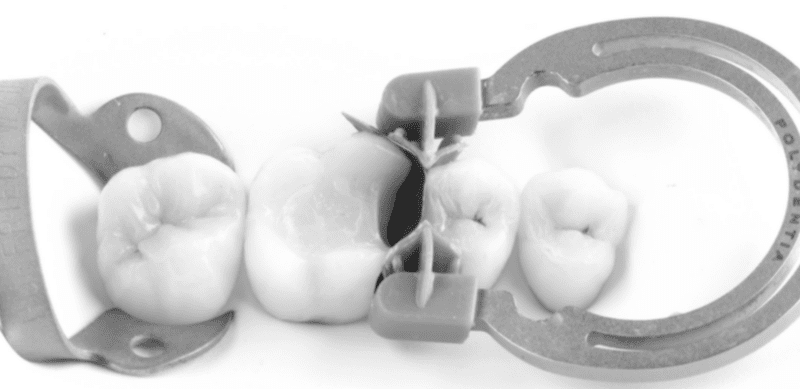 Imersão em Soluções Restauradoras em Dentes Posteriores