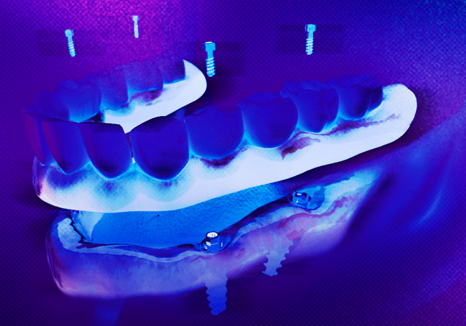Aperfeiçoamento em Prótese sobre Implante + Prótese Fixa